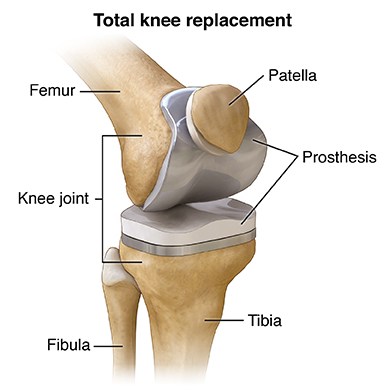 image of knee showcasing metal parts.jpg